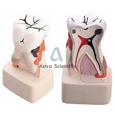 Dental Pathology Model