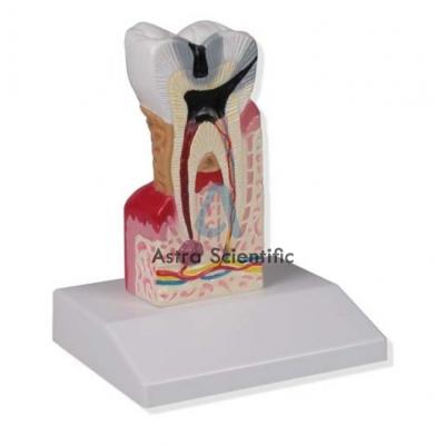 Lower Molar With Caries