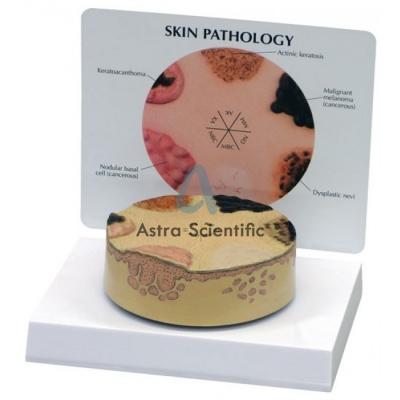 Skin Cancer Model